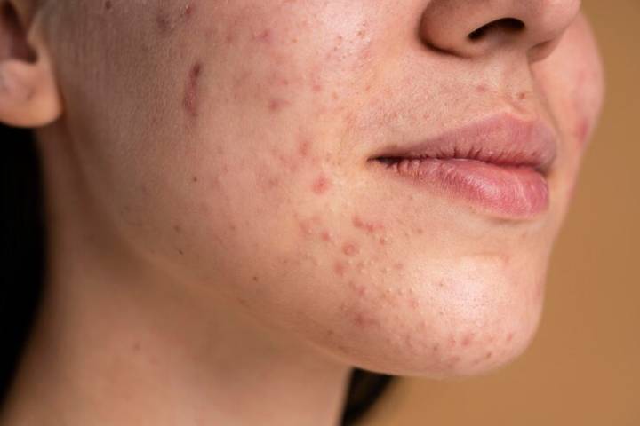 acne-puede-aparecer-a-cualquier-edad-pero-es-mas-comun-en-la-adolescencia imagen de artículo